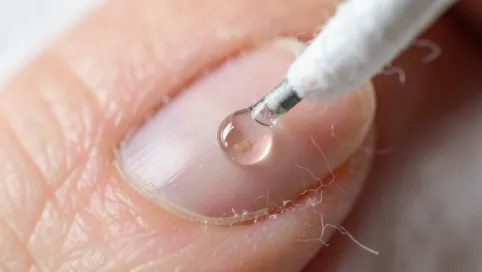 Czy acetonem można odtłuścić płytkę paznokcia