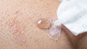 Czym zmyć klej cyjanoakrylowy ze skóry