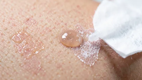 Czym zmyć klej cyjanoakrylowy ze skóry